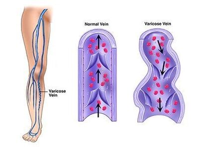 Neoveris prevents the development of venous pathology