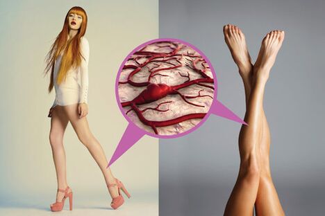Varicose veins on the feet