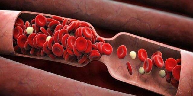 Prevention of blood clots
