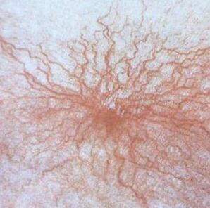 Teleangiectasia