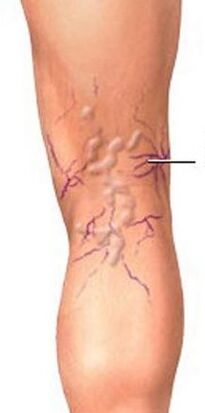 Varicose veins