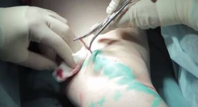 Surgical intervention