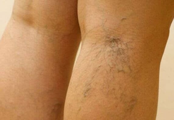 varicose veins