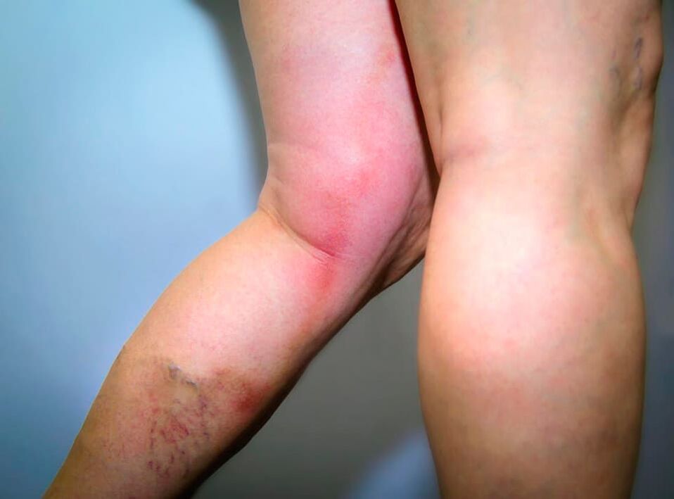 As a result of varicose veins