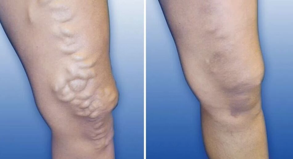 The level of varicose veins