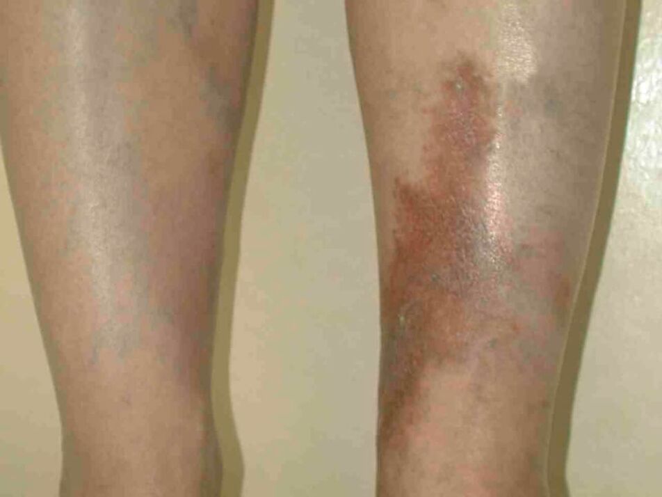 Varicose vein stage
