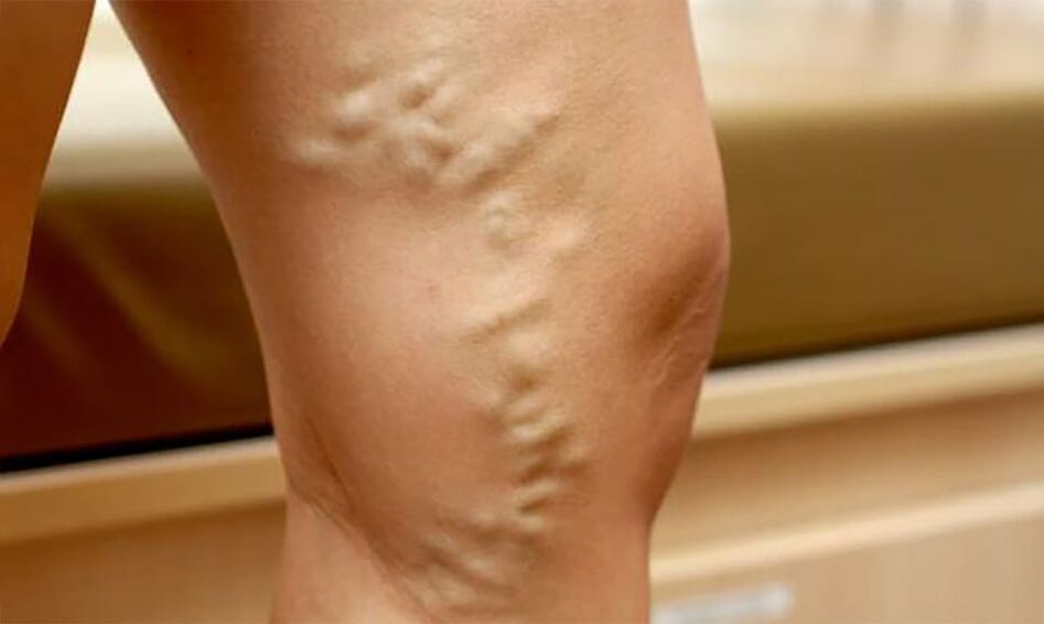 varicose veins in the feet