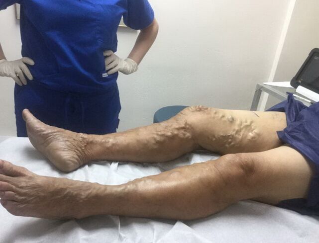 How to recognize varicose veins