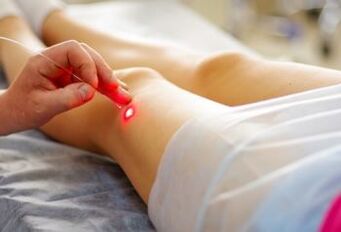 Laser treatment against varicose veins