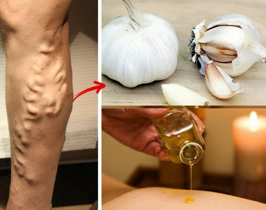 Medicines for varicose veins