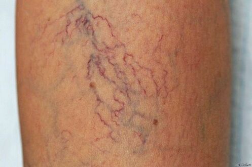 Why are varicose veins dangerous