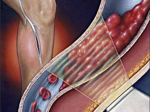 Deep vein thrombosis