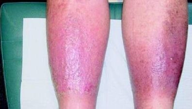 third stage varicose veins on the legs
