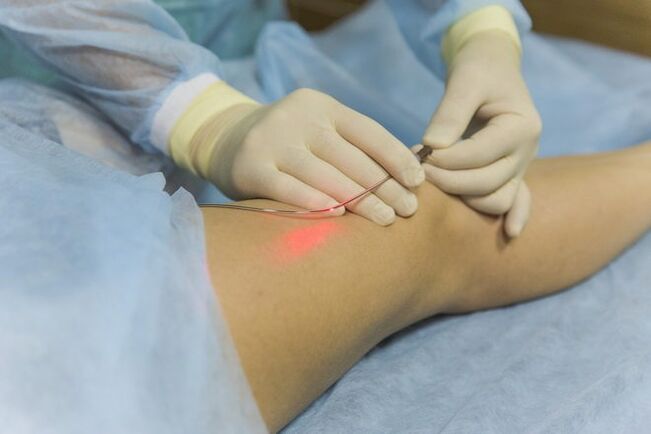 Laser treatment of varicose veins