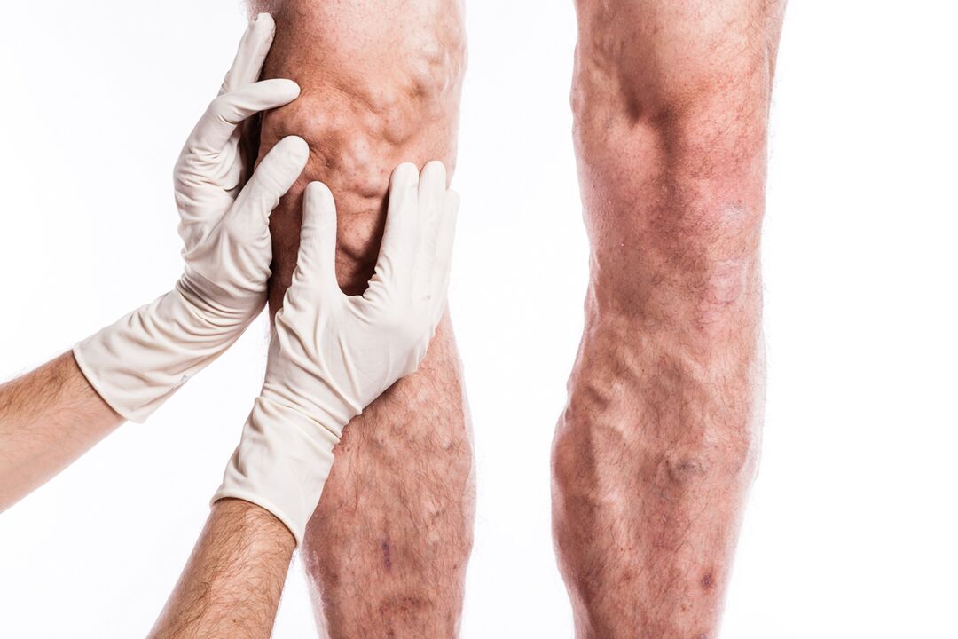 A phlebologist examines the leg of a patient with varicose veins