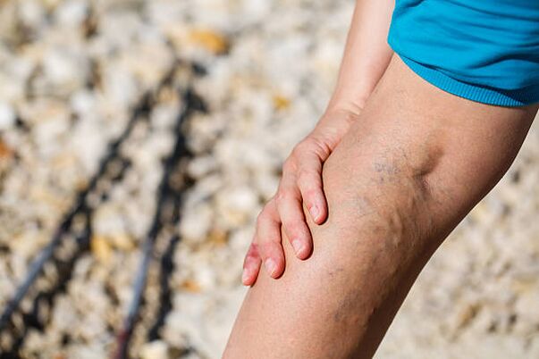 varicose veins in the legs