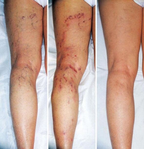 Varicose veins on the lower legs