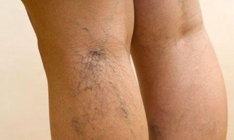 varicose veins in the legs