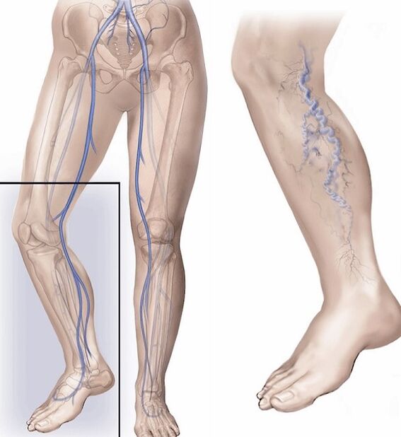 veins and healthy veins affected by varicose veins