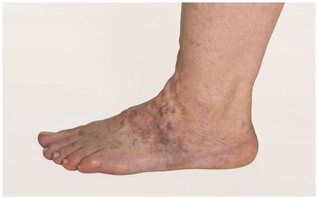 Varicose veins on male legs, complicated by trophic ulcers