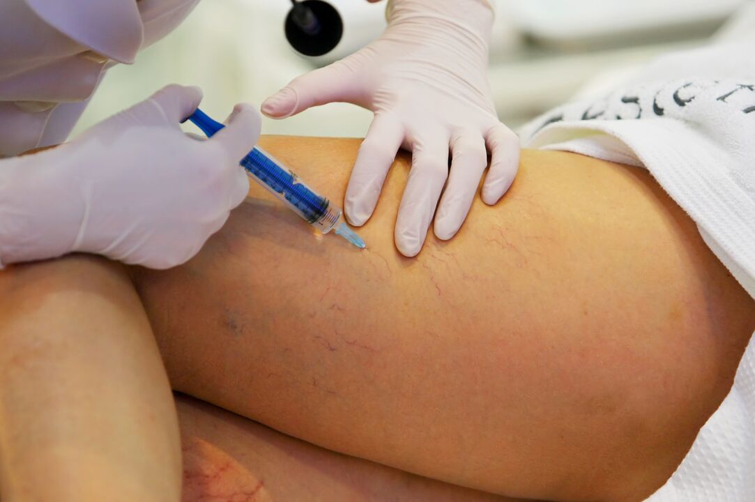 injections for the treatment of varicose veins