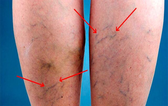 Prominent veins in the legs with varicose veins