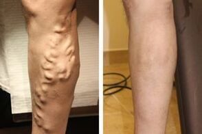 As a result of surgery to remove varicose veins of the legs