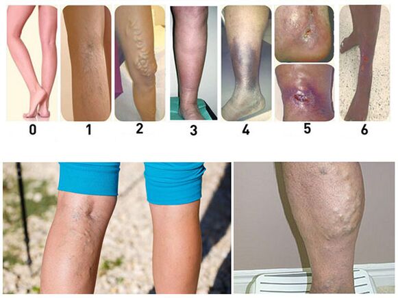 Stages of development of varicose veins in the lower leg