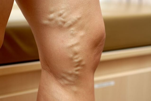 Prominent deformed veins on the legs with stage 3 varicose veins