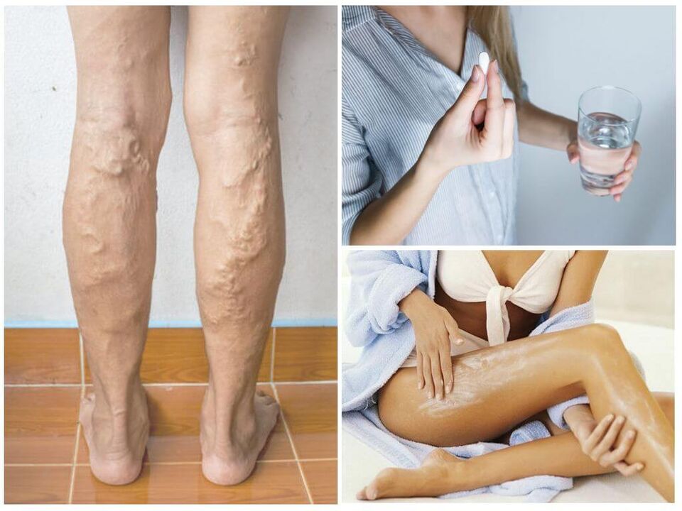 Varicose veins on the lower legs and methods of its treatment