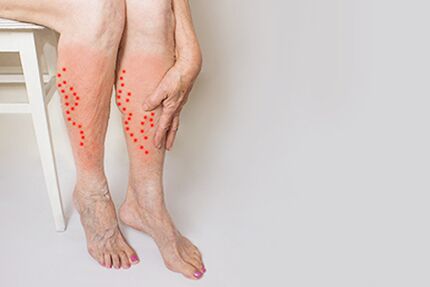 Burning and heaviness in the legs - symptoms of varicose veins