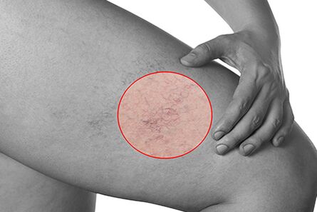 Telangiectasia in varicose veins in the lower leg