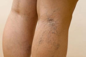 pictures of varicose veins on the legs