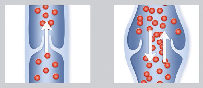 Healthy and damaged venous valves