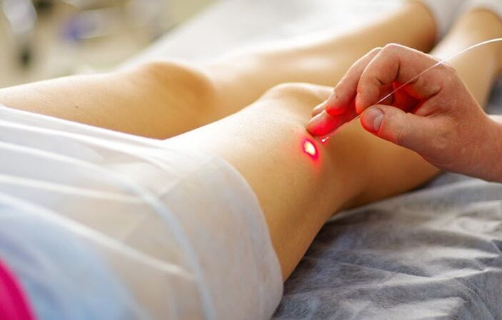 Laser method to treat varicose veins